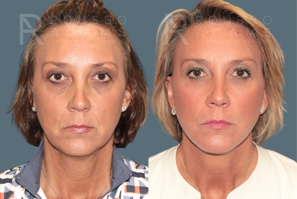 MiniLift<span class=small>By Dr. Austin Adams</span> Before & After Gallery - Patient 243135 - Image 1