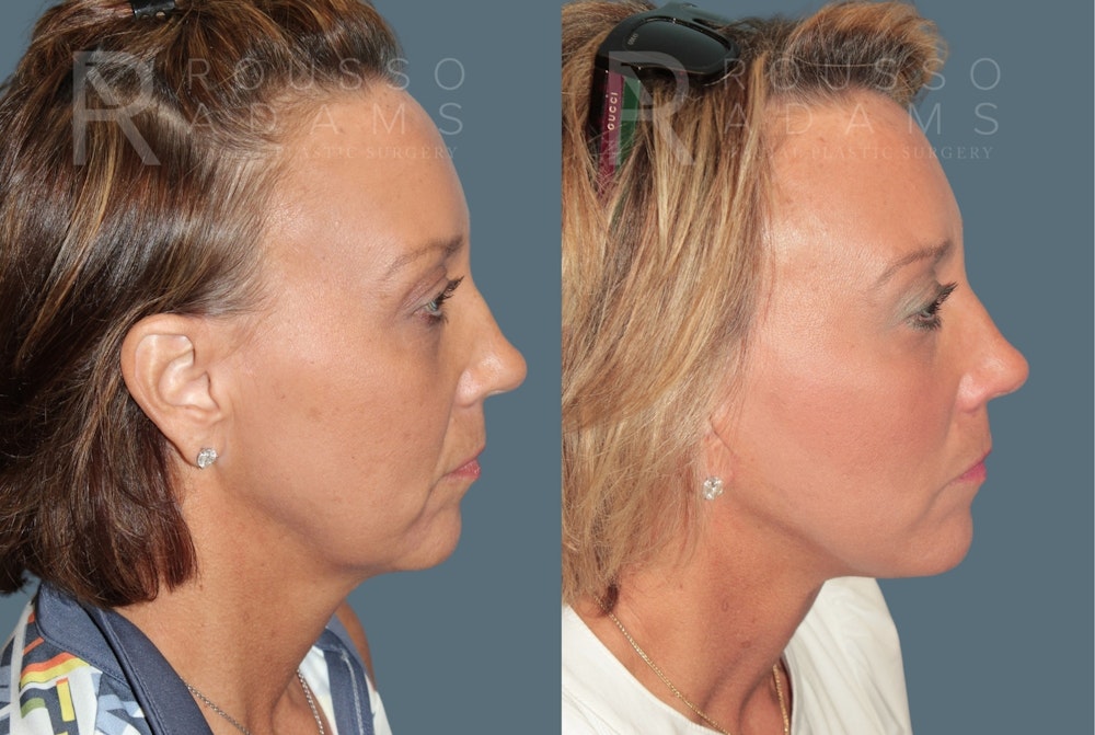 MiniLift<span class=small>By Dr. Austin Adams</span> Before & After Gallery - Patient 243135 - Image 3