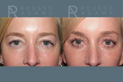 Blepharoplasty<span class=small>By Dr. Austin Adams</span> Before & After Gallery - Patient 237292 - Image 1