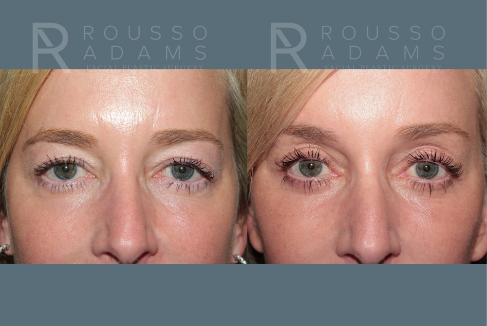 Blepharoplasty<span class=small>By Dr. Austin Adams</span> Before & After Gallery - Patient 237292 - Image 1
