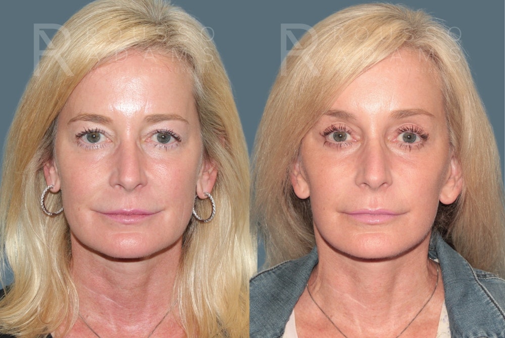 Blepharoplasty<span class=small>By Dr. Austin Adams</span> Before & After Gallery - Patient 237292 - Image 3