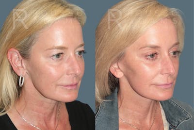MiniLift<span class=small>By Dr. Austin Adams</span> Before & After Gallery - Patient 230743 - Image 2
