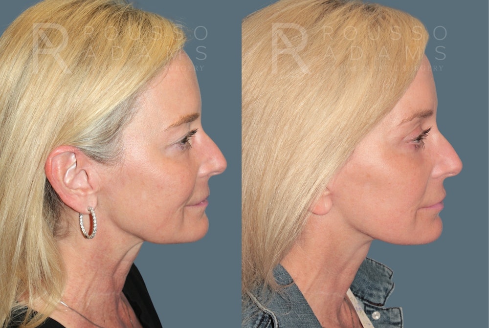 MiniLift<span class=small>By Dr. Austin Adams</span> Before & After Gallery - Patient 230743 - Image 3
