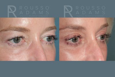 Blepharoplasty<span class=small>By Dr. Austin Adams</span> Before & After Gallery - Patient 237292 - Image 2
