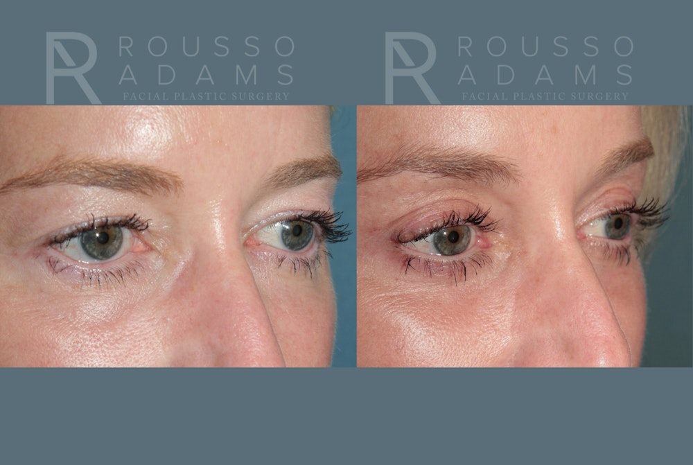 Blepharoplasty<span class=small>By Dr. Austin Adams</span> Before & After Gallery - Patient 237292 - Image 2