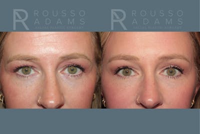 Blepharoplasty<span class=small>By Dr. Austin Adams</span> Before & After Gallery - Patient 885836 - Image 1