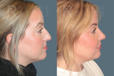 Rhinoplasty<span class=small>By Dr. Austin Adams</span> Before & After Gallery - Patient 182735 - Image 1