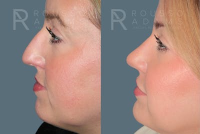 Rhinoplasty<span class=small>By Dr. Austin Adams</span> Before & After Gallery - Patient 182735 - Image 4