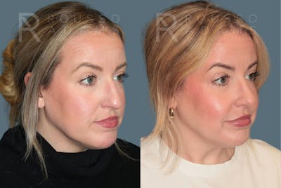 Rhinoplasty<span class=small>By Dr. Austin Adams</span> Before & After Gallery - Patient 182735 - Image 2