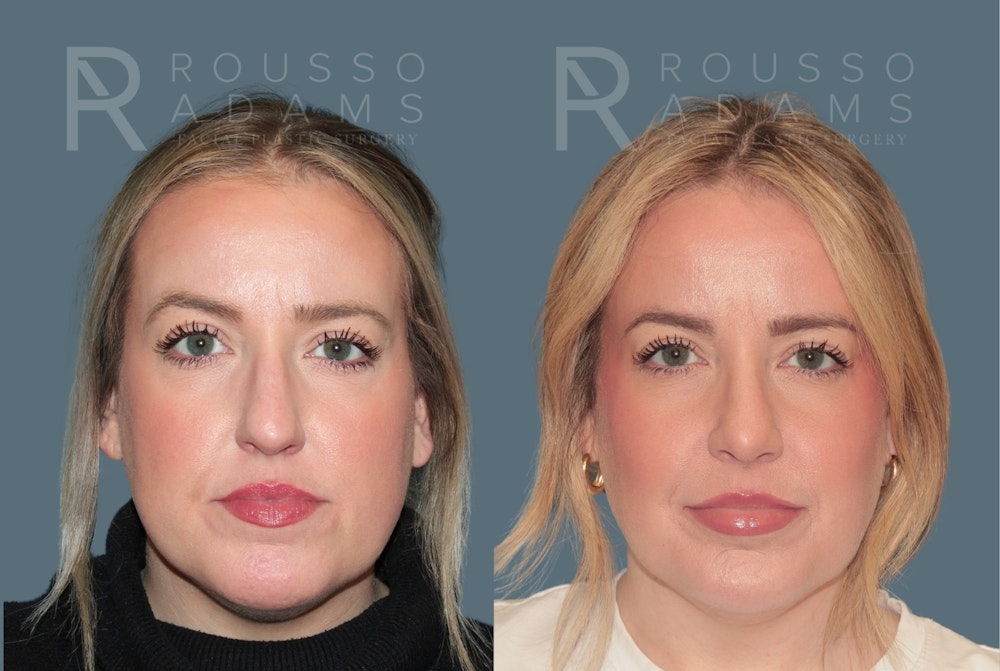 Rhinoplasty<span class=small>By Dr. Austin Adams</span> Before & After Gallery - Patient 182735 - Image 3
