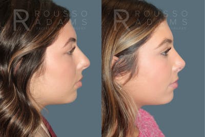 Rhinoplasty<span class=small>By Dr. Austin Adams</span> Before & After Gallery - Patient 178820 - Image 1