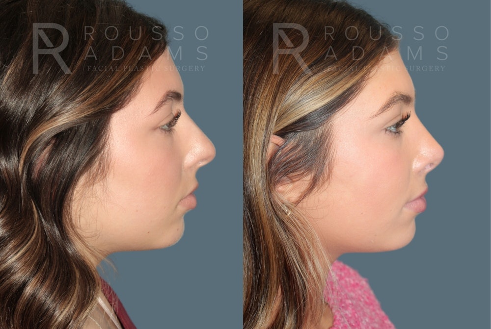 Rhinoplasty<span class=small>By Dr. Austin Adams</span> Before & After Gallery - Patient 178820 - Image 1