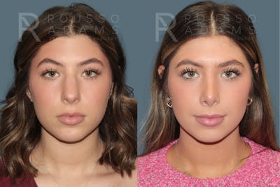 Rhinoplasty<span class=small>By Dr. Austin Adams</span> Before & After Gallery - Patient 178820 - Image 4