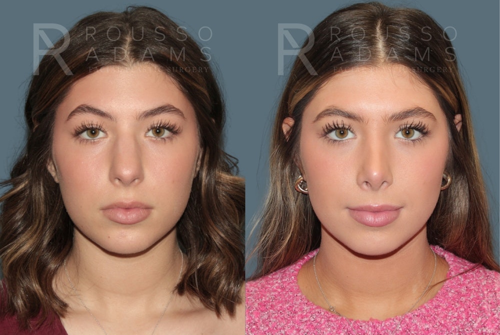 Rhinoplasty<span class=small>By Dr. Austin Adams</span> Before & After Gallery - Patient 178820 - Image 4