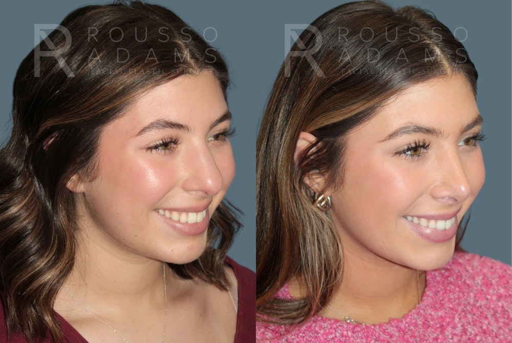 Rhinoplasty<span class=small>By Dr. Austin Adams</span> Before & After Gallery - Patient 178820 - Image 3