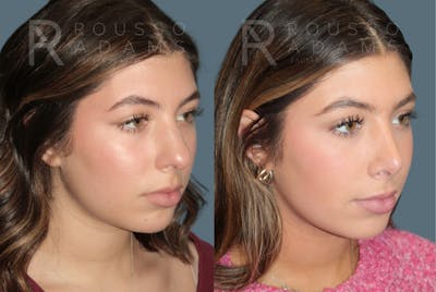 Rhinoplasty<span class=small>By Dr. Austin Adams</span> Before & After Gallery - Patient 178820 - Image 2
