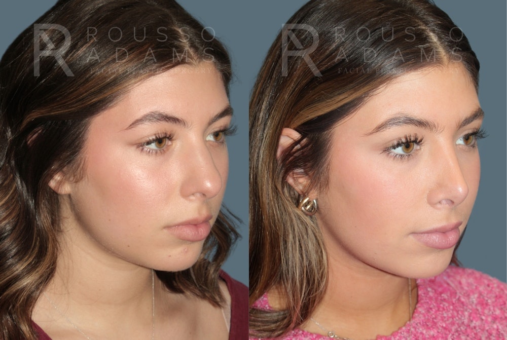 Rhinoplasty<span class=small>By Dr. Austin Adams</span> Before & After Gallery - Patient 178820 - Image 2