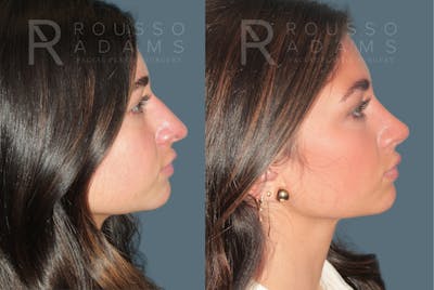 Rhinoplasty<span class=small>By Dr. Austin Adams</span> Before & After Gallery - Patient 347407 - Image 1