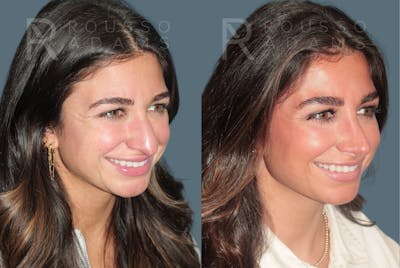 Rhinoplasty<span class=small>By Dr. Austin Adams</span> Before & After Gallery - Patient 347407 - Image 2