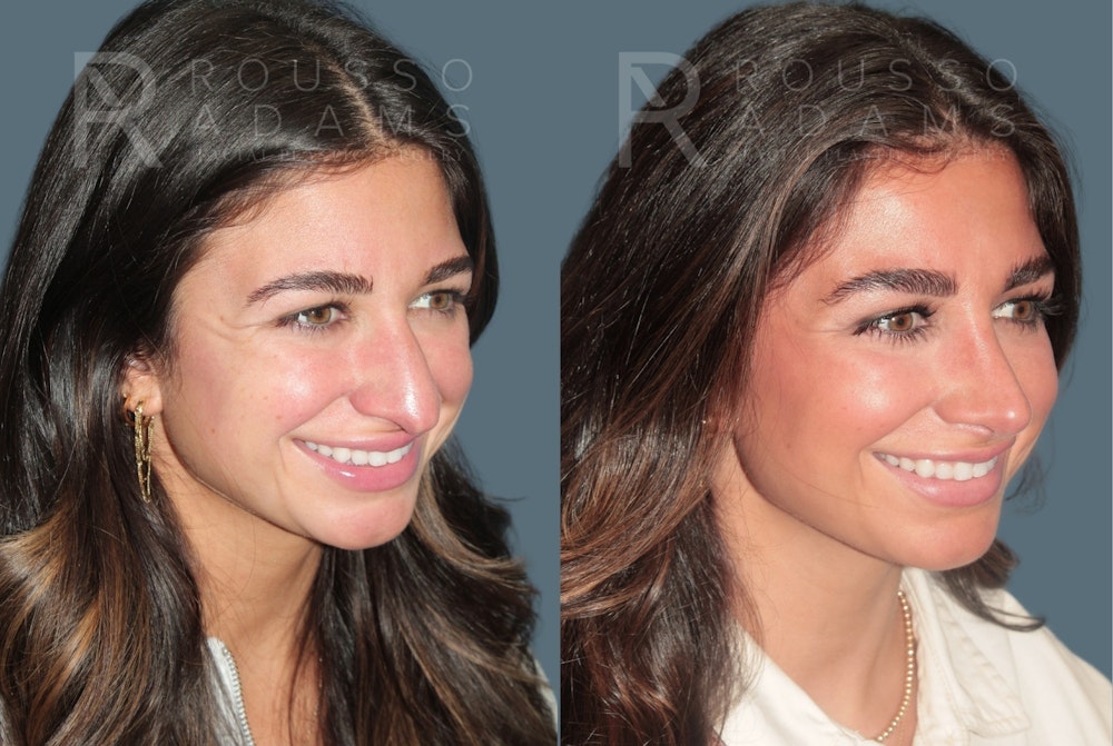 Rhinoplasty<span class=small>By Dr. Austin Adams</span> Before & After Gallery - Patient 347407 - Image 2
