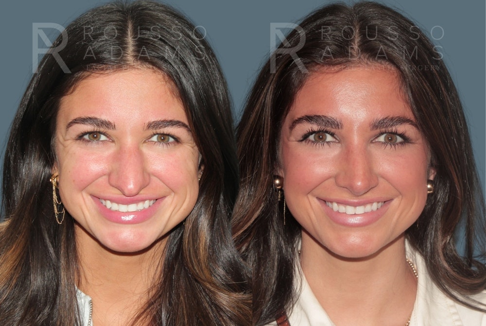Rhinoplasty<span class=small>By Dr. Austin Adams</span> Before & After Gallery - Patient 347407 - Image 3