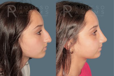 Rhinoplasty<span class=small>By Dr. Austin Adams</span> Before & After Gallery - Patient 203862 - Image 1