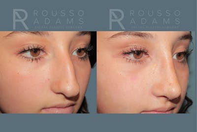 Rhinoplasty<span class=small>By Dr. Austin Adams</span> Before & After Gallery - Patient 203862 - Image 2