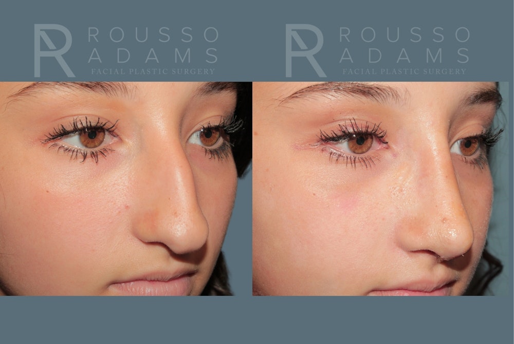 Rhinoplasty<span class=small>By Dr. Austin Adams</span> Before & After Gallery - Patient 203862 - Image 2
