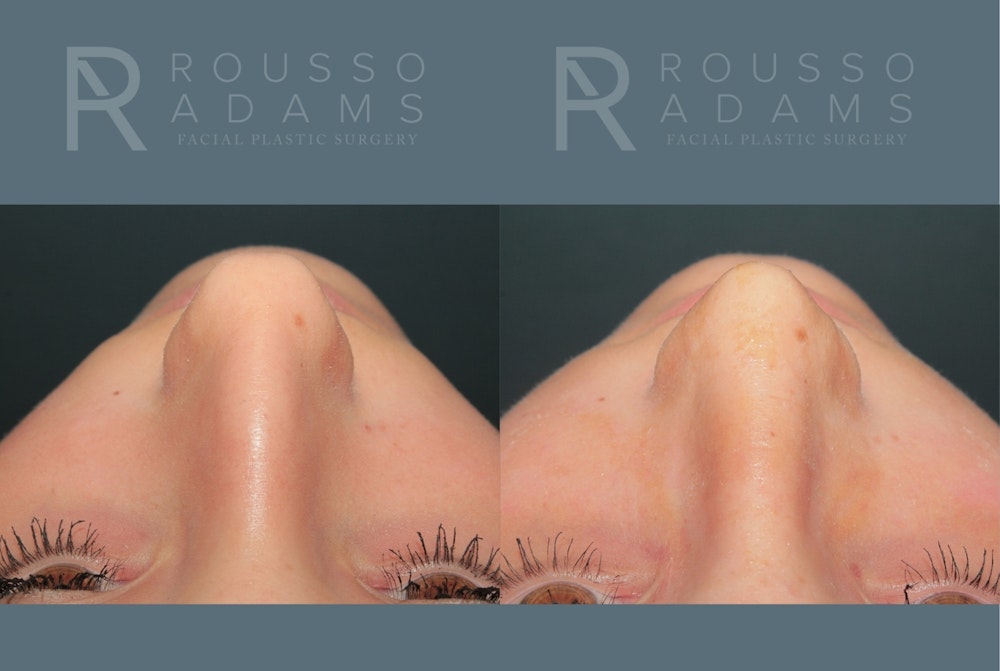Rhinoplasty<span class=small>By Dr. Austin Adams</span> Before & After Gallery - Patient 203862 - Image 3