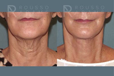 Facelift <span class=small>By Dr. Austin Adams</span> Before & After Gallery - Patient 117593 - Image 4