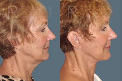 Facelift <span class=small>By Dr. Austin Adams</span> Before & After Gallery - Patient 117593 - Image 2
