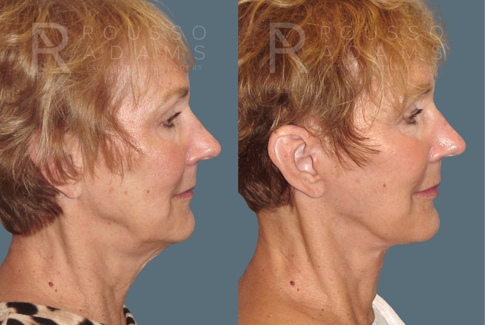 Facelift <span class=small>By Dr. Austin Adams</span> Before & After Gallery - Patient 117593 - Image 2