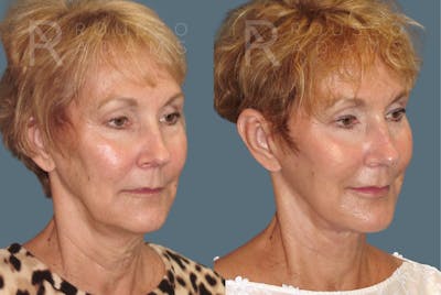 Facelift <span class=small>By Dr. Austin Adams</span> Before & After Gallery - Patient 117593 - Image 1