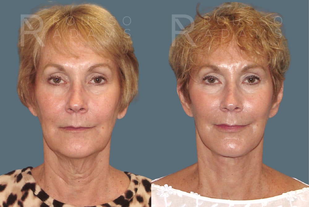 Facelift <span class=small>By Dr. Austin Adams</span> Before & After Gallery - Patient 117593 - Image 3