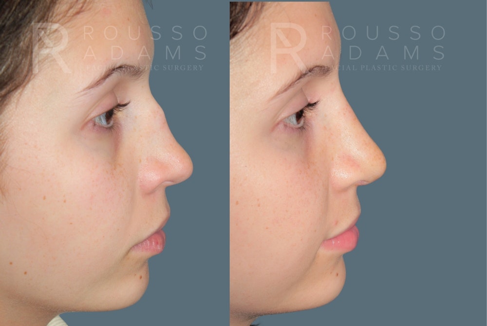 Revision Rhinoplasty<span class=small>By Dr. Austin Adams</span> Before & After Gallery - Patient 351734 - Image 4