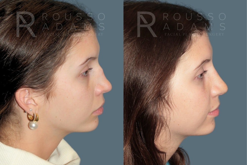 Revision Rhinoplasty<span class=small>By Dr. Austin Adams</span> Before & After Gallery - Patient 351734 - Image 1