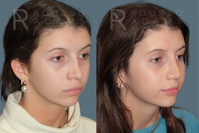Revision Rhinoplasty<span class=small>By Dr. Austin Adams</span> Before & After Gallery - Patient 351734 - Image 2