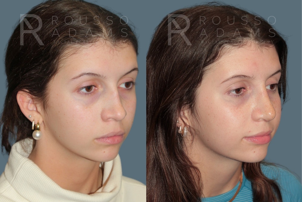 Revision Rhinoplasty<span class=small>By Dr. Austin Adams</span> Before & After Gallery - Patient 351734 - Image 2