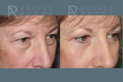 Blepharoplasty <span class=small>By Dr. Daniel Rousso</span> Before & After Gallery - Patient 292936 - Image 2