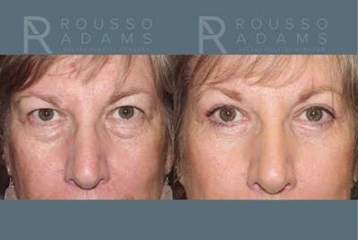Blepharoplasty <span class=small>By Dr. Daniel Rousso</span> Before & After Gallery - Patient 292936 - Image 1