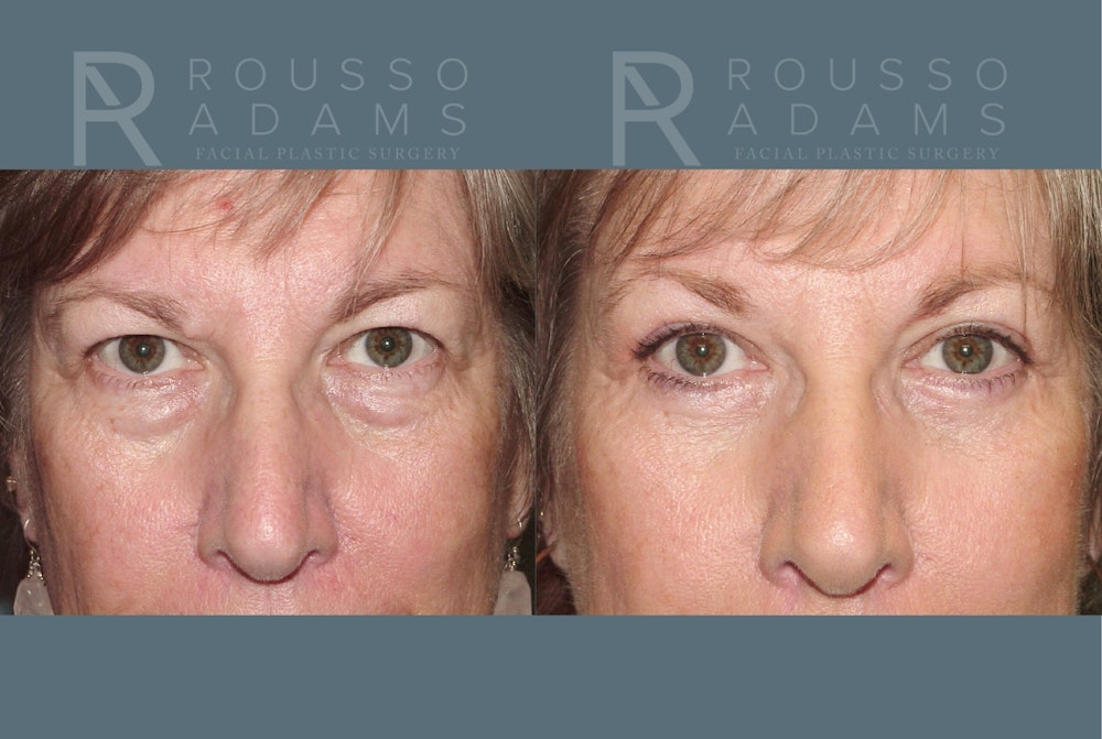 Blepharoplasty <span class=small>By Dr. Daniel Rousso</span> Before & After Gallery - Patient 292936 - Image 1