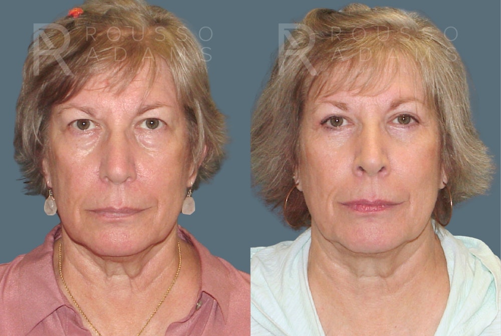 Blepharoplasty <span class=small>By Dr. Daniel Rousso</span> Before & After Gallery - Patient 292936 - Image 3