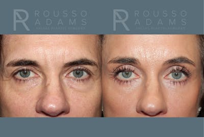 Blepharoplasty <span class=small>By Dr. Daniel Rousso</span> Before & After Gallery - Patient 878536 - Image 1