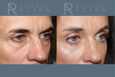 Blepharoplasty <span class=small>By Dr. Daniel Rousso</span> Before & After Gallery - Patient 878536 - Image 2