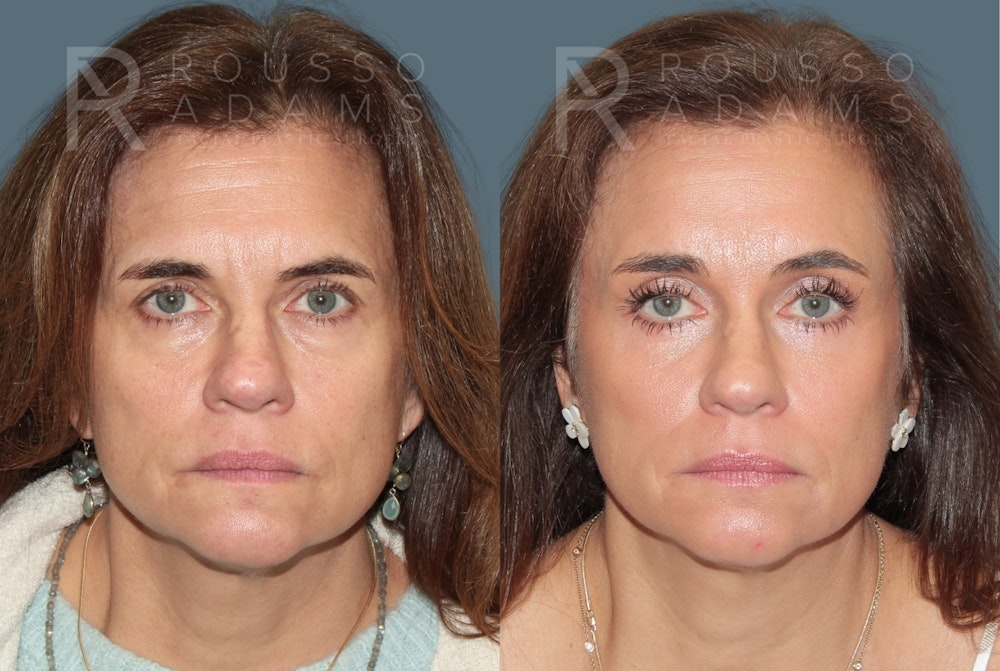 Blepharoplasty <span class=small>By Dr. Daniel Rousso</span> Before & After Gallery - Patient 878536 - Image 3