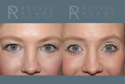 Blepharoplasty <span class=small>By Dr. Daniel Rousso</span> Before & After Gallery - Patient 455321 - Image 1