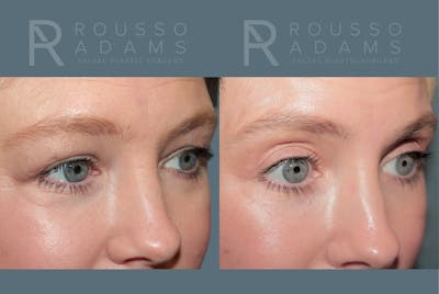 Blepharoplasty <span class=small>By Dr. Daniel Rousso</span> Before & After Gallery - Patient 455321 - Image 2