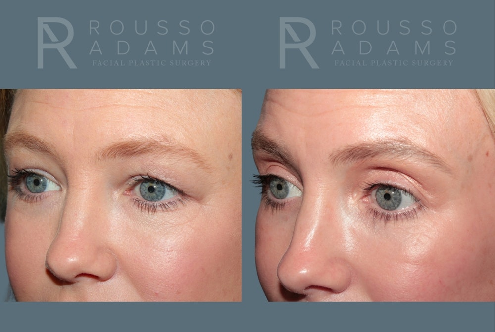 Blepharoplasty <span class=small>By Dr. Daniel Rousso</span> Before & After Gallery - Patient 455321 - Image 3