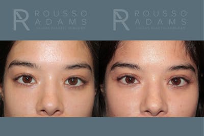 Blepharoplasty <span class=small>By Dr. Daniel Rousso</span> Before & After Gallery - Patient 226308 - Image 1