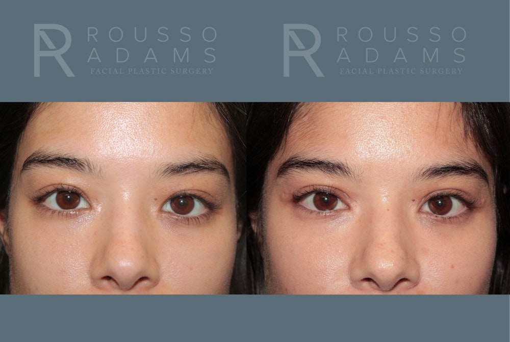 Blepharoplasty <span class=small>By Dr. Daniel Rousso</span> Before & After Gallery - Patient 226308 - Image 1